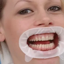 دهان‌ بازکن اپتراگیت OptraGate